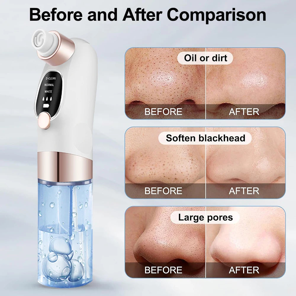 Aspirateur de Points Noirs Luméa – Nettoyeur de Pores & Soin Visage Profond